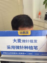 体验后-大麦微针植发丨全国连锁