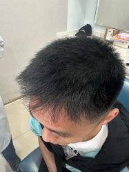 -大麦微针植发丨全国连锁
