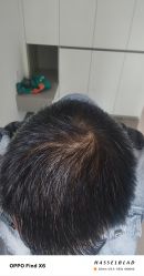 -碧莲盛·不剃发植发