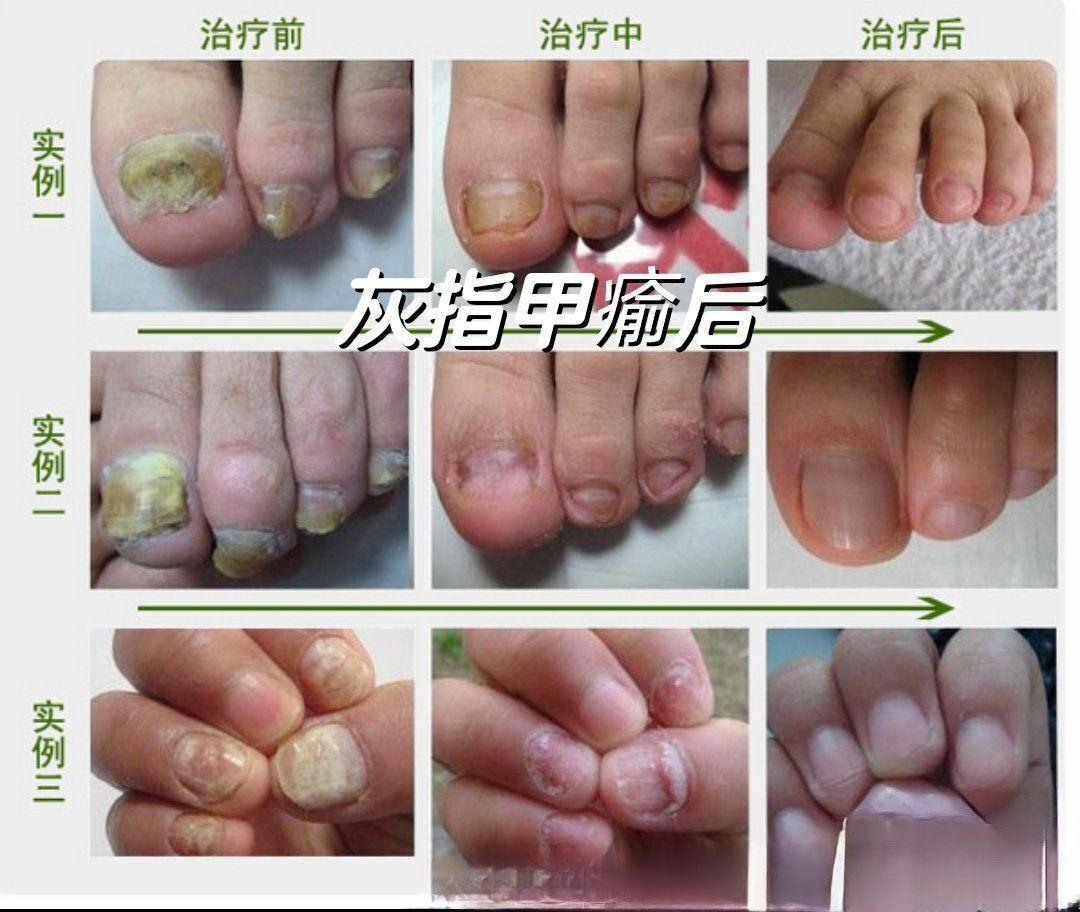 灰指甲变美的过程