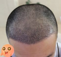 -大麦微针植发丨全国连锁