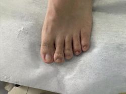 -德哥灰指甲脚气甲沟炎跖疣护理