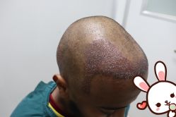 -大麦微针植发丨全国连锁