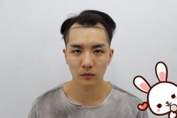 点击看大图 -大麦微针植发丨全国连锁