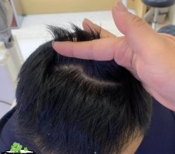 -大麦微针植发丨全国连锁