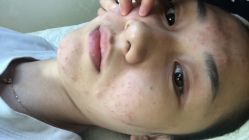 -苗颜坊专业祛痘全国连锁机构