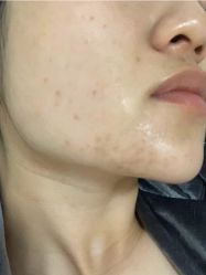 -苗方清颜痘肌研究所