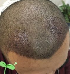 -大麦微针植发丨全国连锁