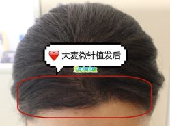 -大麦微针植发全国连锁