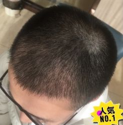 -大麦微针植发丨全国连锁