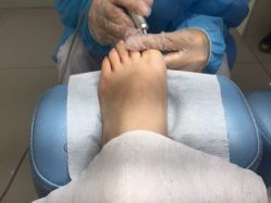 -派恩宜灰指甲鸡眼嵌甲手足癣