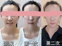 -颜和骨正&明星徒手小颜整骨