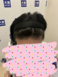 -大麦微针植发丨全国连锁