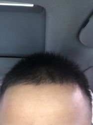 -碧莲盛·不剃发植发