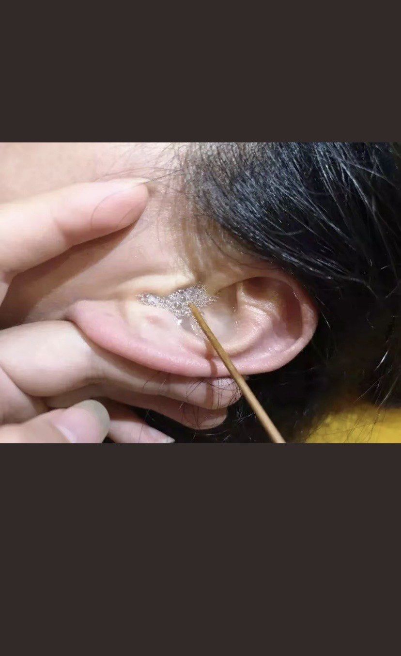 n👉保持耳部清洁: 通过采耳可以有效地清除耳朵内的耳垢,皮屑和