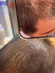 -碧莲盛·不剃发植发