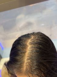 -碧莲盛·不剃发植发