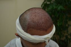 -大麦微针植发丨全国连锁