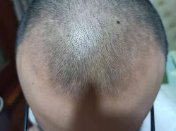 -大麦微针植发丨全国连锁