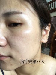 -爱莎扁平疣·汗管瘤·斑痣中心
