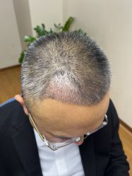 体验后-大麦微针植发全国连锁