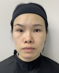 -广州健丽·去眼袋医疗美容机构