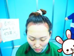 -大麦微针植发丨全国连锁