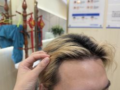 -碧莲盛·不剃发植发