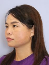 -天津健丽·去眼袋医疗美容机构