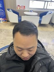 体验后-大麦微针植发全国连锁