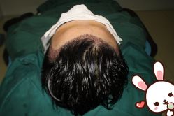 点击看大图 -大麦微针植发丨全国连锁