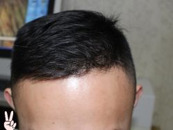 -大麦微针植发丨全国连锁