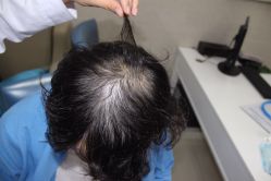 -大麦微针植发全国连锁