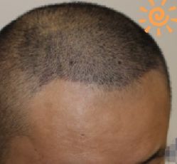 -大麦微针植发丨全国连锁