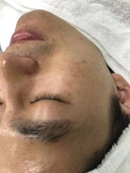 体验后-悟空祛痘·亚健康皮肤管理中心