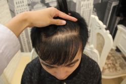 点击看大图 -大麦微针植发丨全国连锁