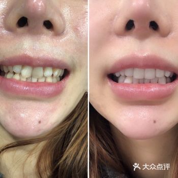 90%的明星都在用的“牙贴面”究竟是什么