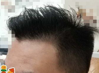 -大麦微针植发丨全国连锁