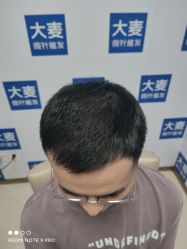 体验后-大麦微针植发丨全国连锁