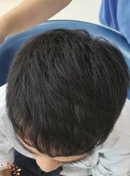 -大麦微针植发丨全国连锁