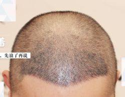 -大麦微针植发全国连锁