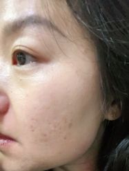 -痣清宫祛斑祛痣连锁店