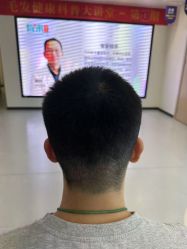 -大麦微针植发全国连锁
