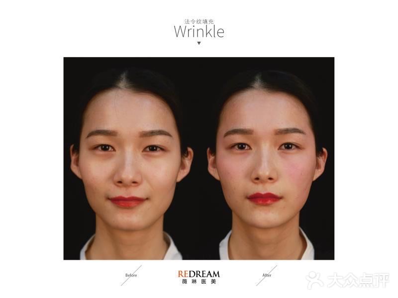 玻尿酸的功效真是太强大了！！