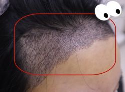 -大麦微针植发全国连锁