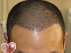 -大麦微针植发丨全国连锁