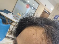 -碧莲盛·不剃发植发