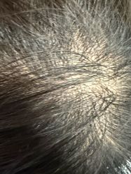 -碧莲盛·不剃发植发