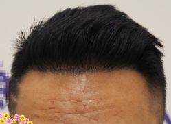 -大麦微针植发全国连锁