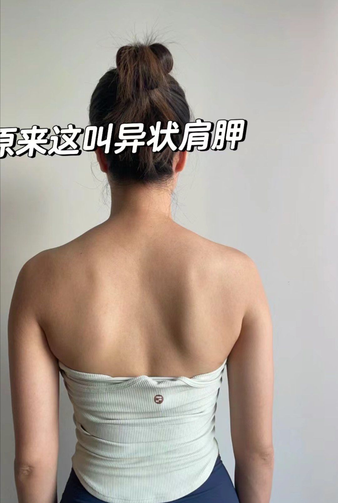 翼状肩胛